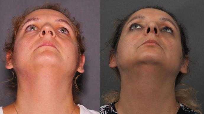 ultrasonic septorhinoplasty dr mireas athens greece  xeiroyrgeio diafragma (2)